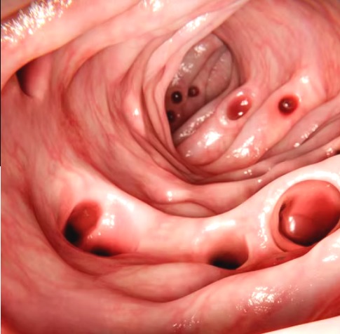 DIVERTÍCULOS EN EL COLON