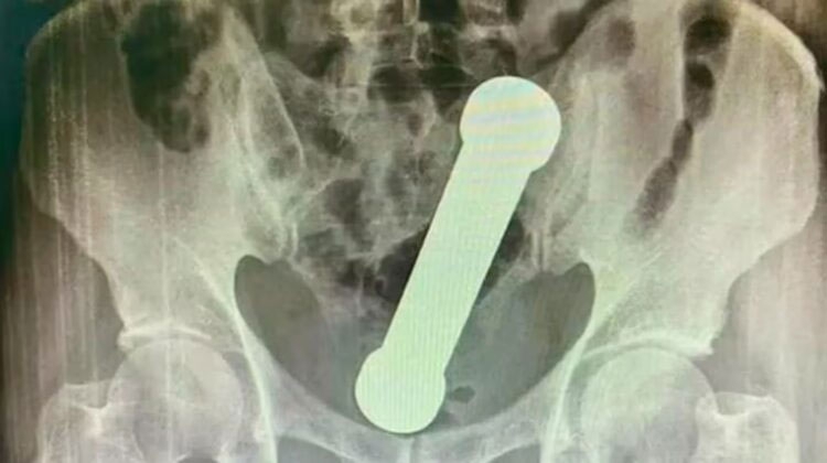 Le extrajeron un objeto del cuerpo luego de participar en un peligroso juego sexual