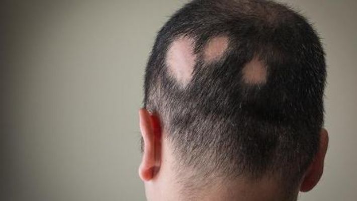 Alopecia: de qué se trata la enfermedad que sufre la mujer de Will Smith y por la que provocó un altercado en plena entrega de los Oscar 2022