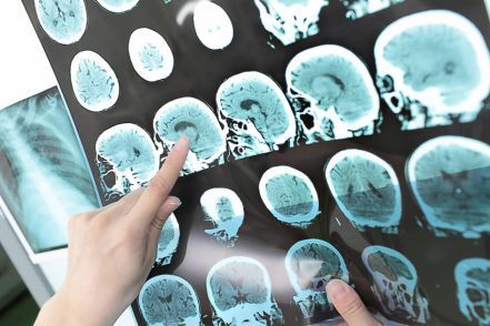 Farmacéutica ocultó un fármaco que podría prevenir el alzhéimer
