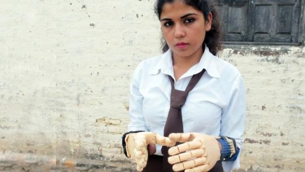 La historia de Camila, la joven termense que logró recuperar sus manos