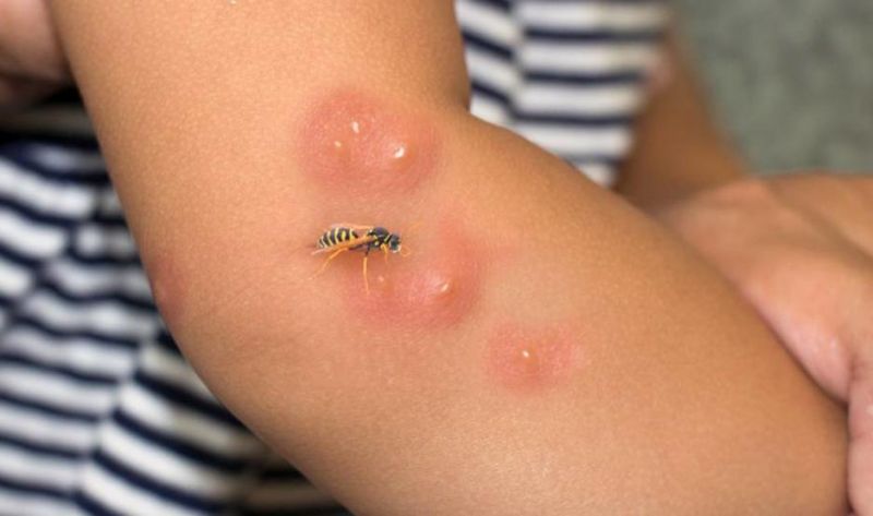 Los mosquitos pueden ocasionar lesiones leves a graves en los niños, con una sola picadura