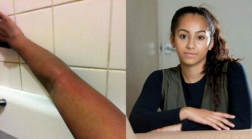 Una adolescente es alérgica al agua, por lo que no puede bañarse sin dolor
