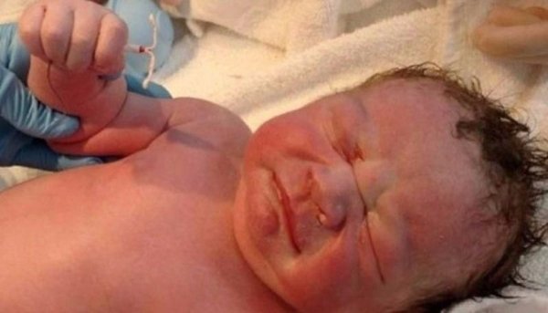 Un bebé nació con el DIU entre sus manos