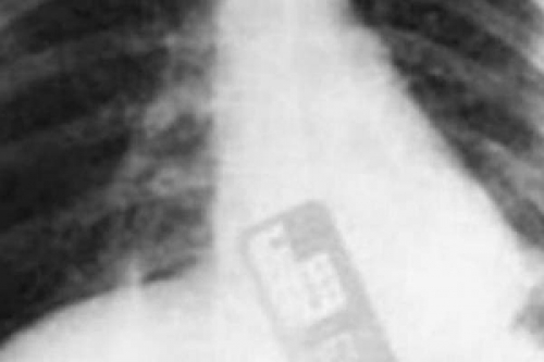 Un profesional: ginecólogo dejó su celular dentro del vientre de una paciente