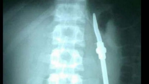 Un preso fue operado porque se tragó una bombilla de mate
