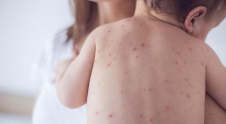 La epidemia de sarampión se dispara en EEUU con más de 500 casos declarados