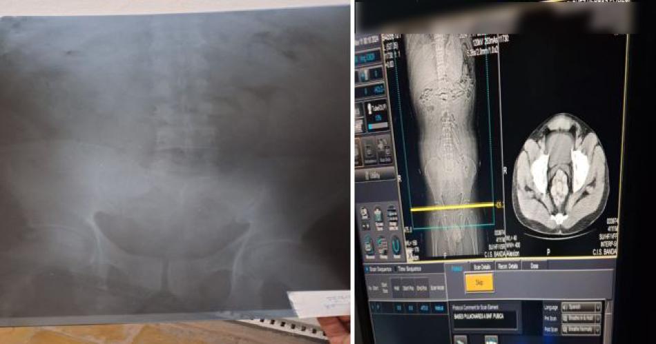IMÁGENES. Así detectaron las cápsulas de cocaína en estómago y vagina de las "mulas"