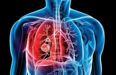 Aumentan casos de tuberculosis en la Argentina