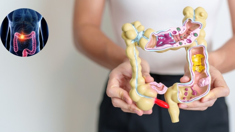 Ensayan medicamento para eliminar el cáncer de colon sin cirugía.