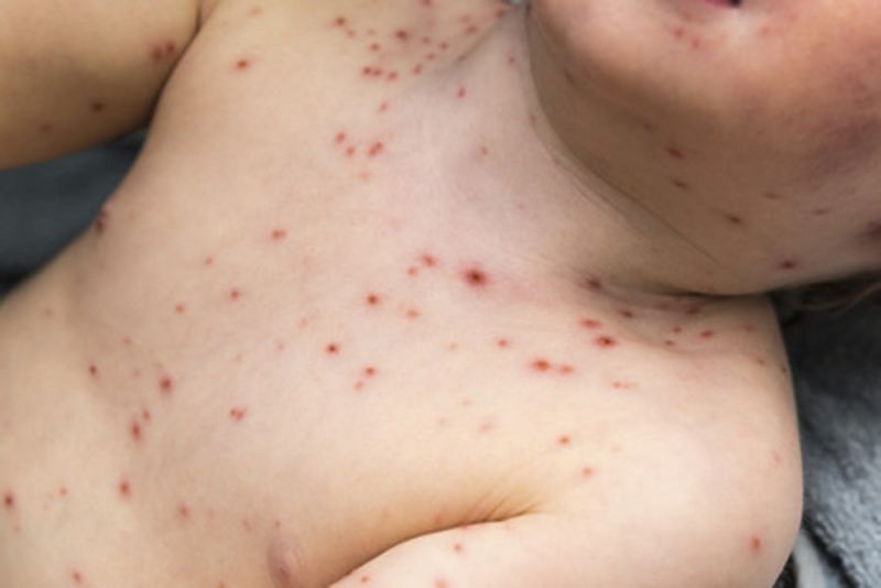 NUEVAS INDICACIONES DE VACUNACIÓN PARA VIAJEROS POR BROTE DE SARAMPIÓN