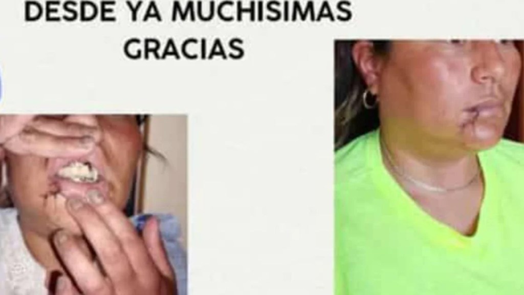 Colecta para una mujer desfigurada