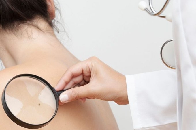 Cáncer de piel: causas y detección en el mes de prevención
